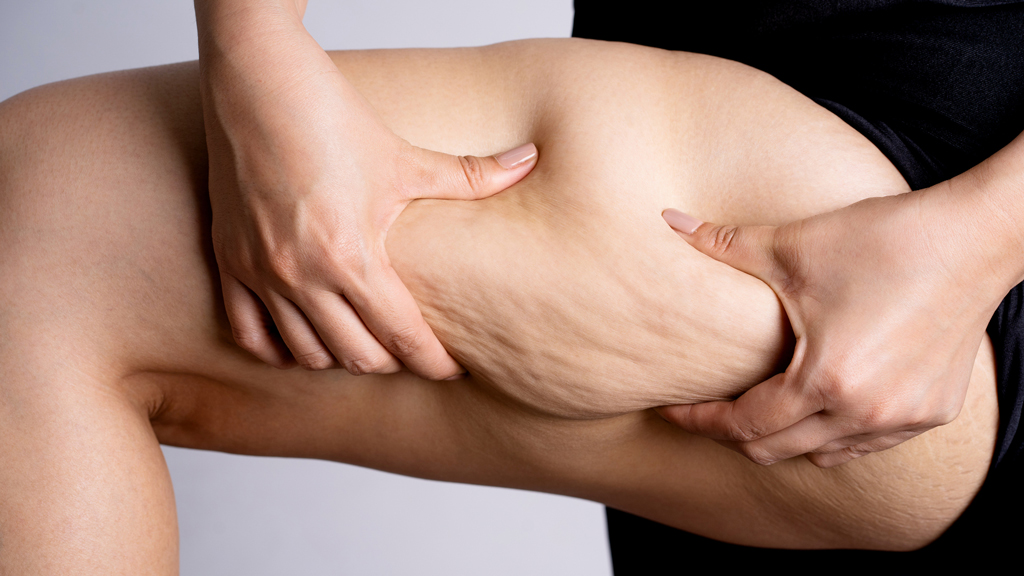 How to Combat Cellulite: Effective Treatments and Tips